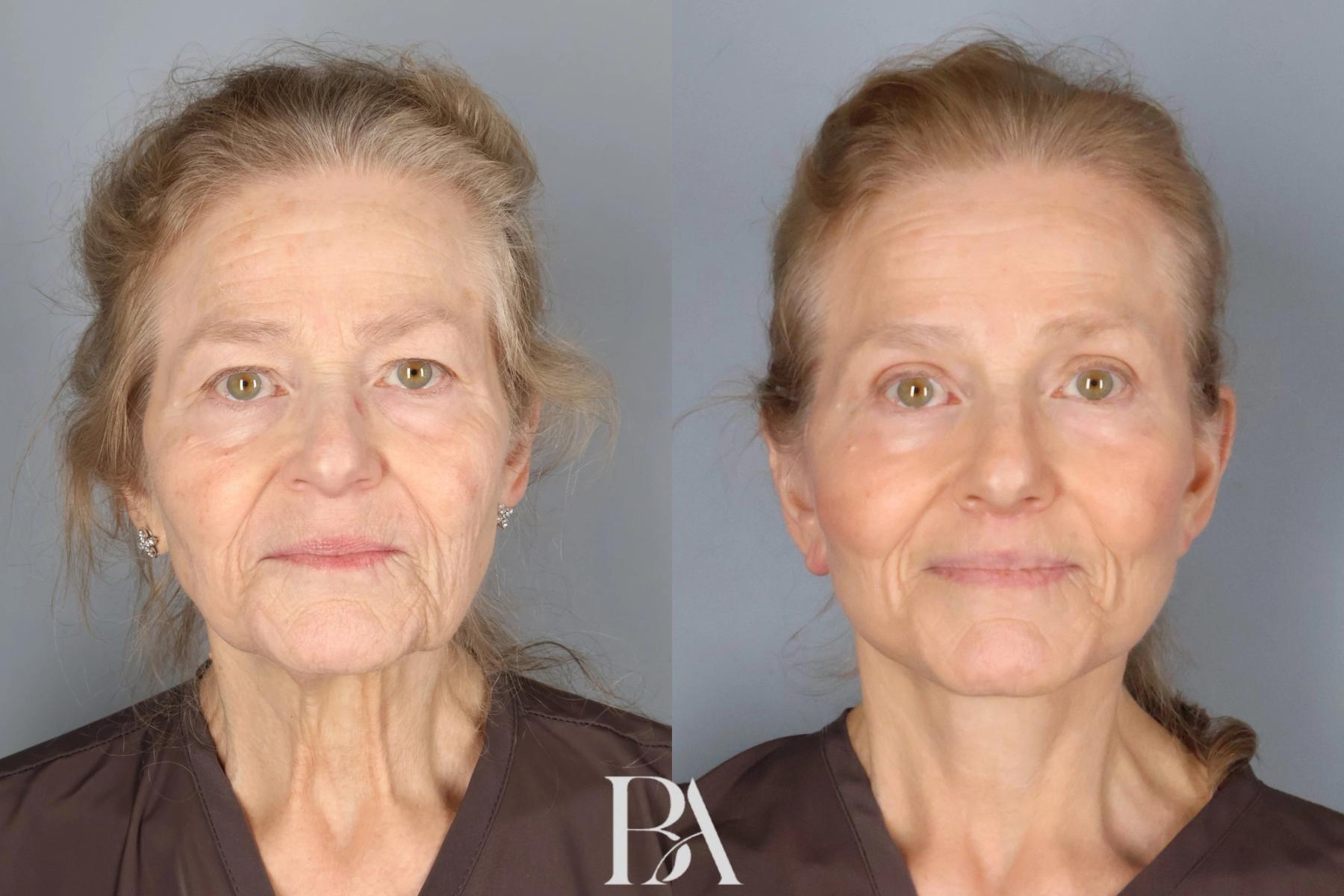 Face/Neck Lift before and after — front view, Dr. Beina Azadgoli, Beverly Hills