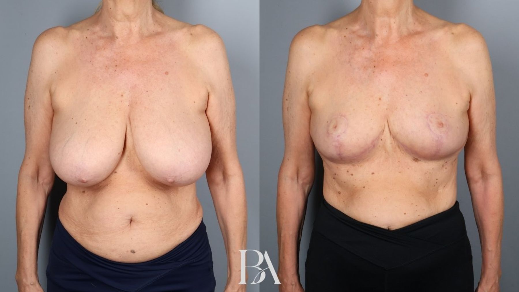 Breast reduction before and after — front view, Dr. Beina Azadgoli, Beverly Hills