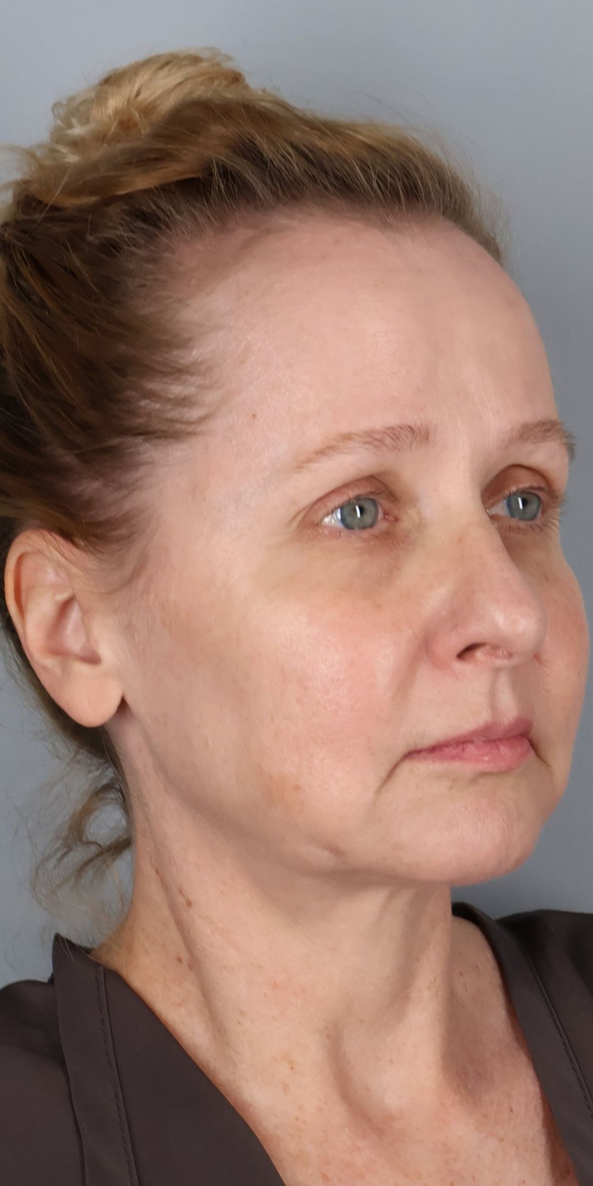 Face/neck lift before — oblique view, Dr. Beina Azadgoli, Beverly Hills