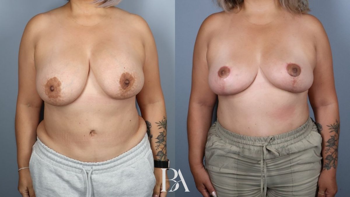 Before and after — Breast Implant Removal (+/- Lift)