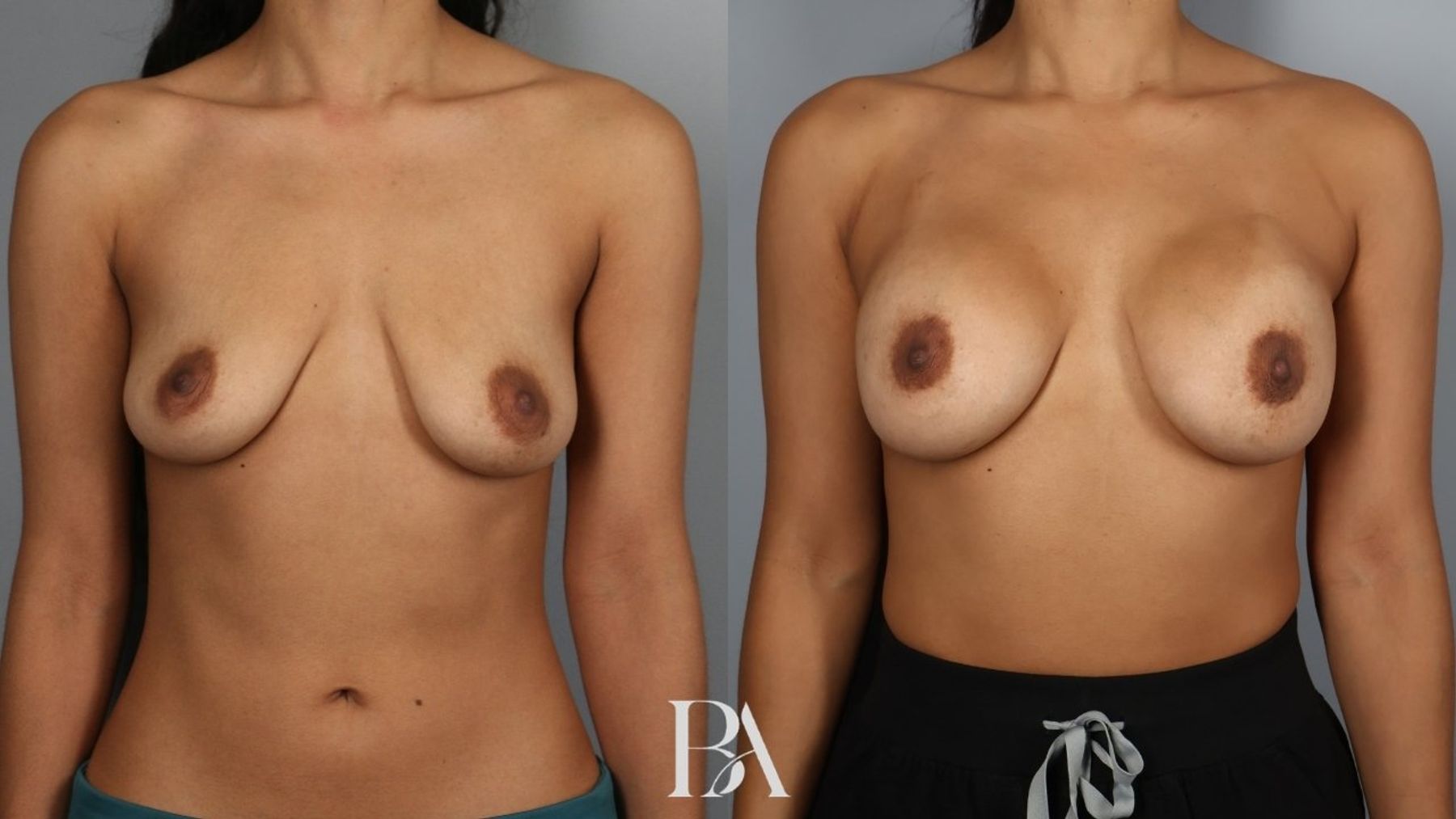 Breast augmentation before and after — front view, Dr. Beina Azadgoli, Beverly Hills