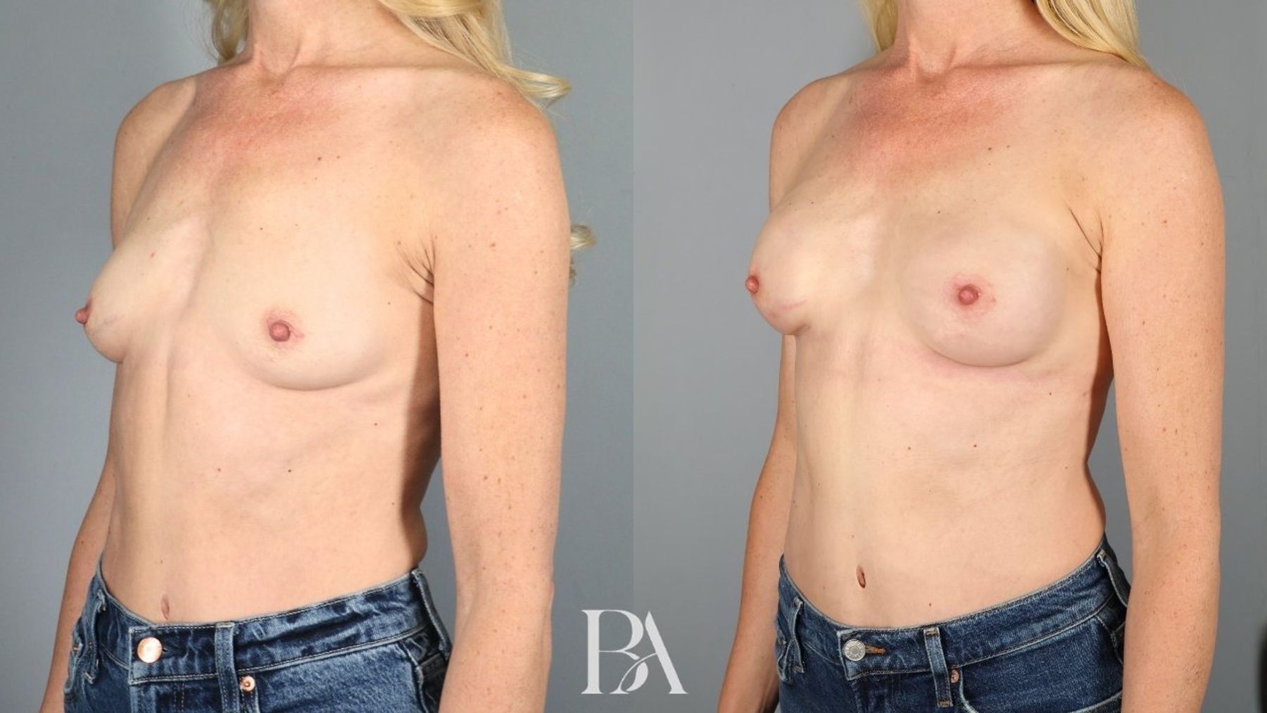 Direct-to-Implant Reconstruction before and after — three-quarter view, Dr. Beina Azadgoli, Beverly Hills