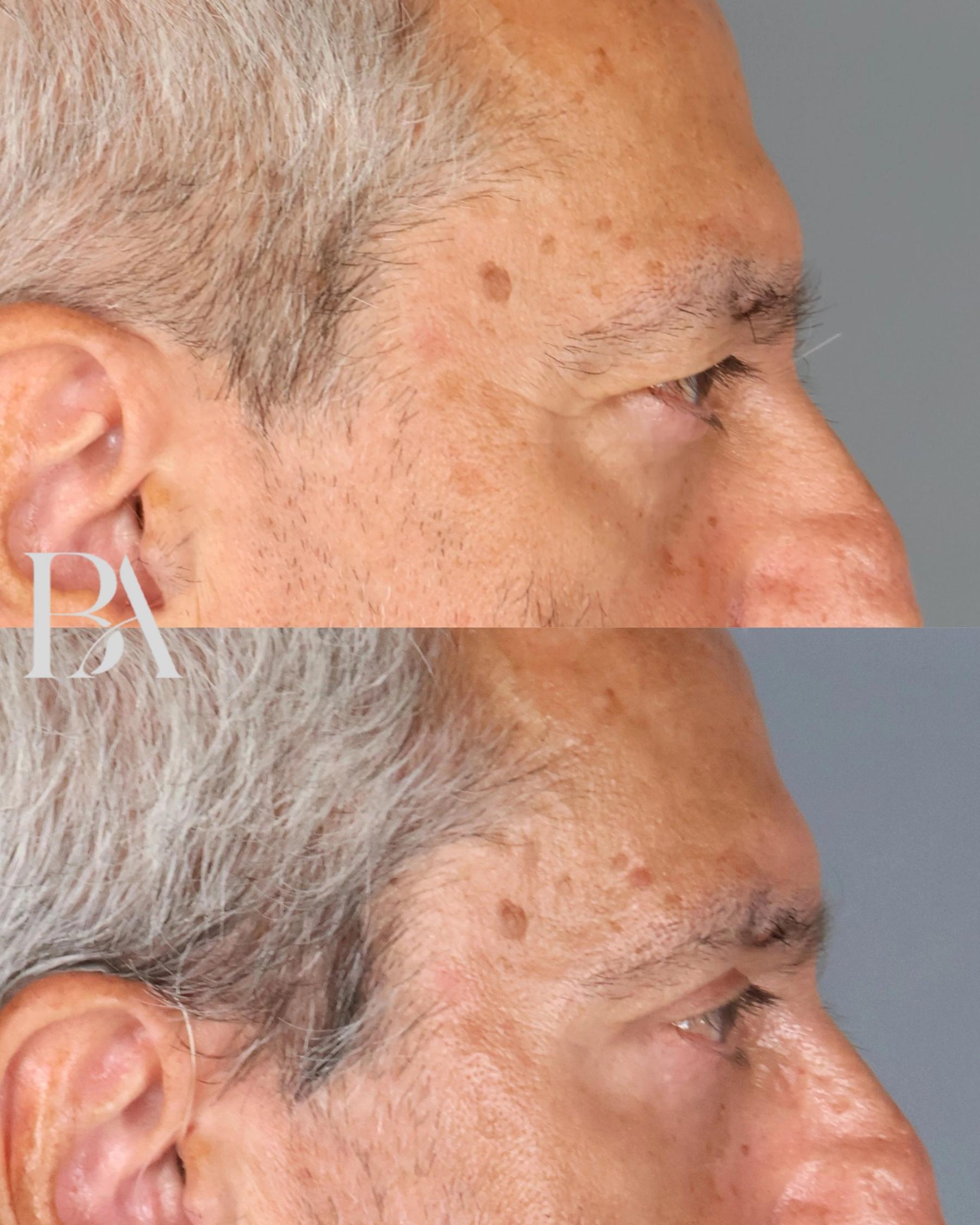 Upper Blepharoplasty before and after — side view, Dr. Beina Azadgoli, Beverly Hills