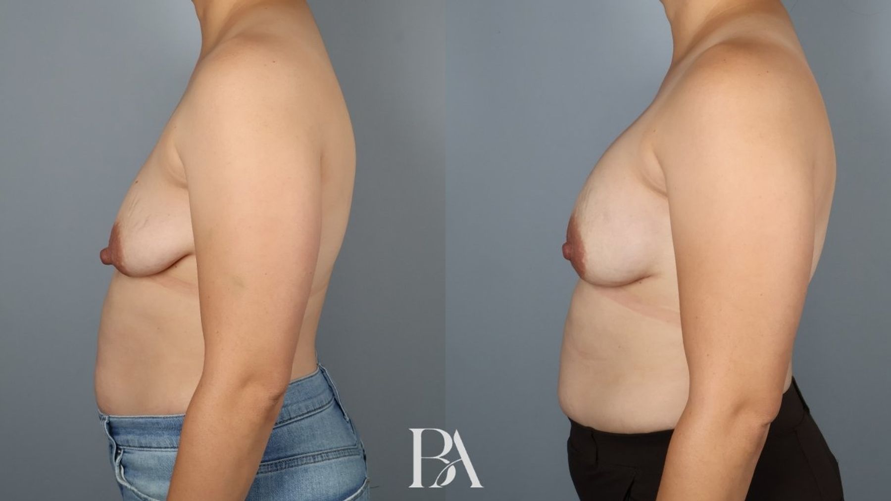 Direct-to-Implant Reconstruction before and after — side view, Dr. Beina Azadgoli, Beverly Hills