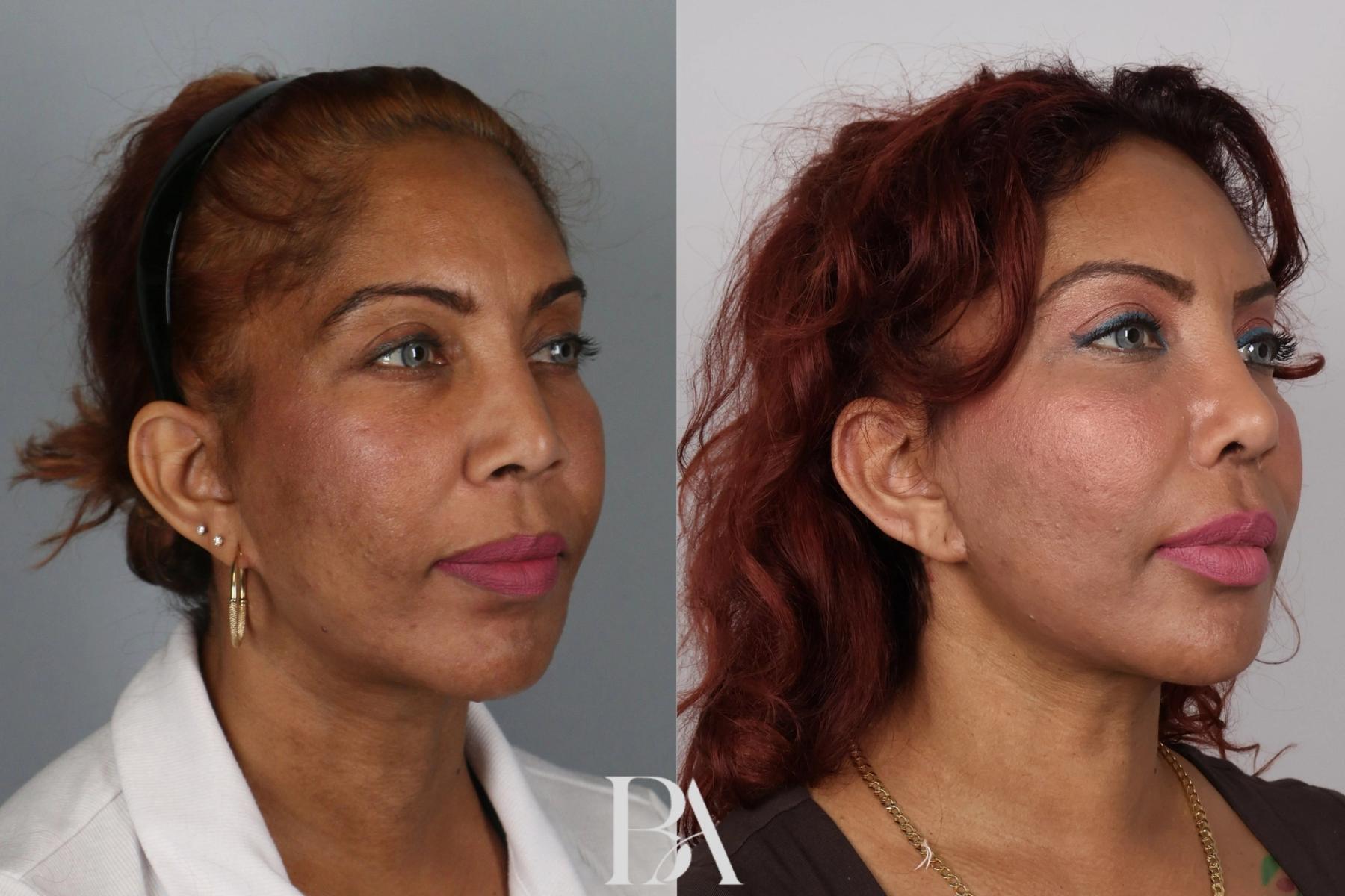 Rhinoplasty before and after — oblique view, Dr. Beina Azadgoli, Beverly Hills