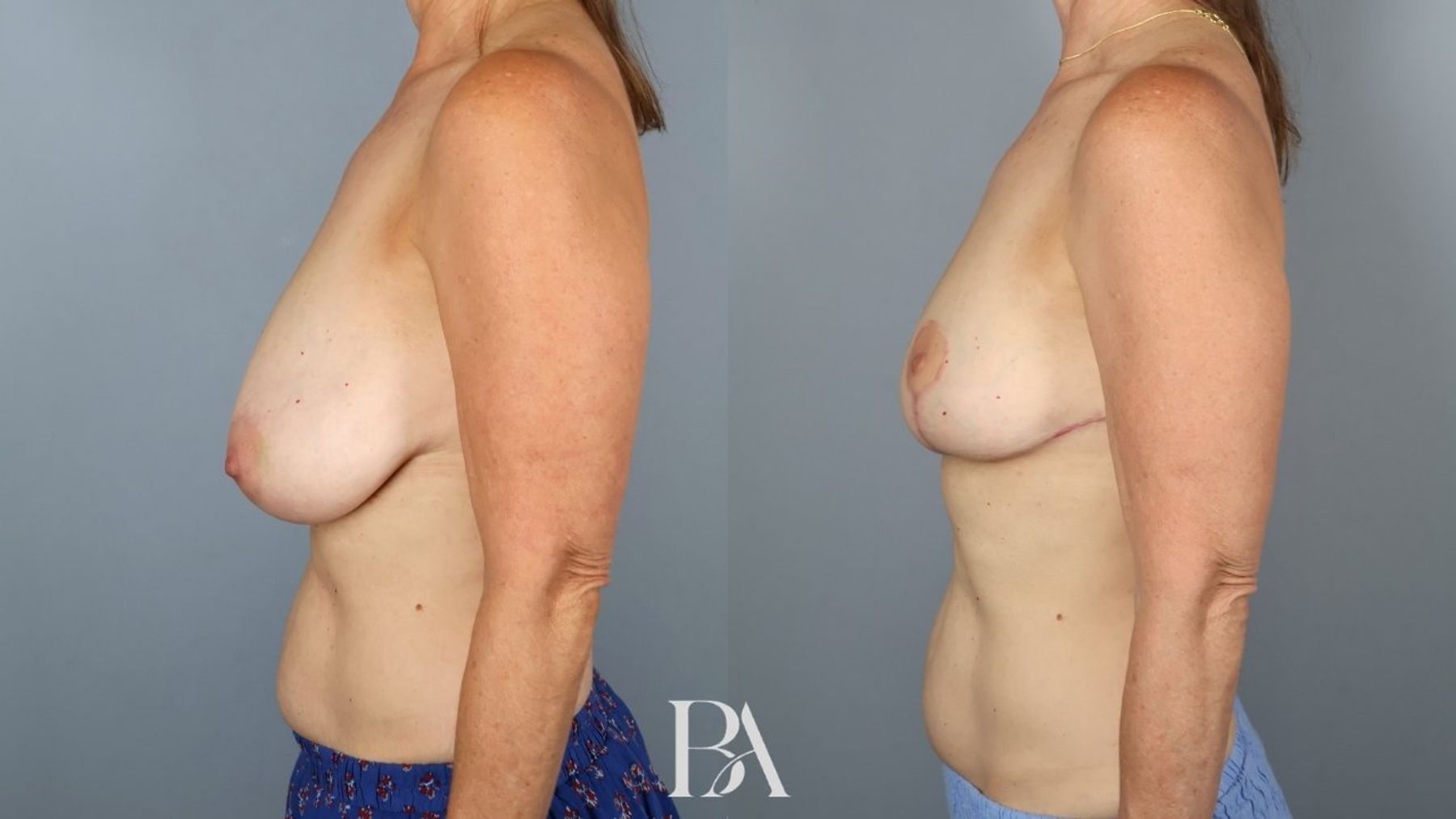 Breast reduction before and after — side view, Dr. Beina Azadgoli, Beverly Hills