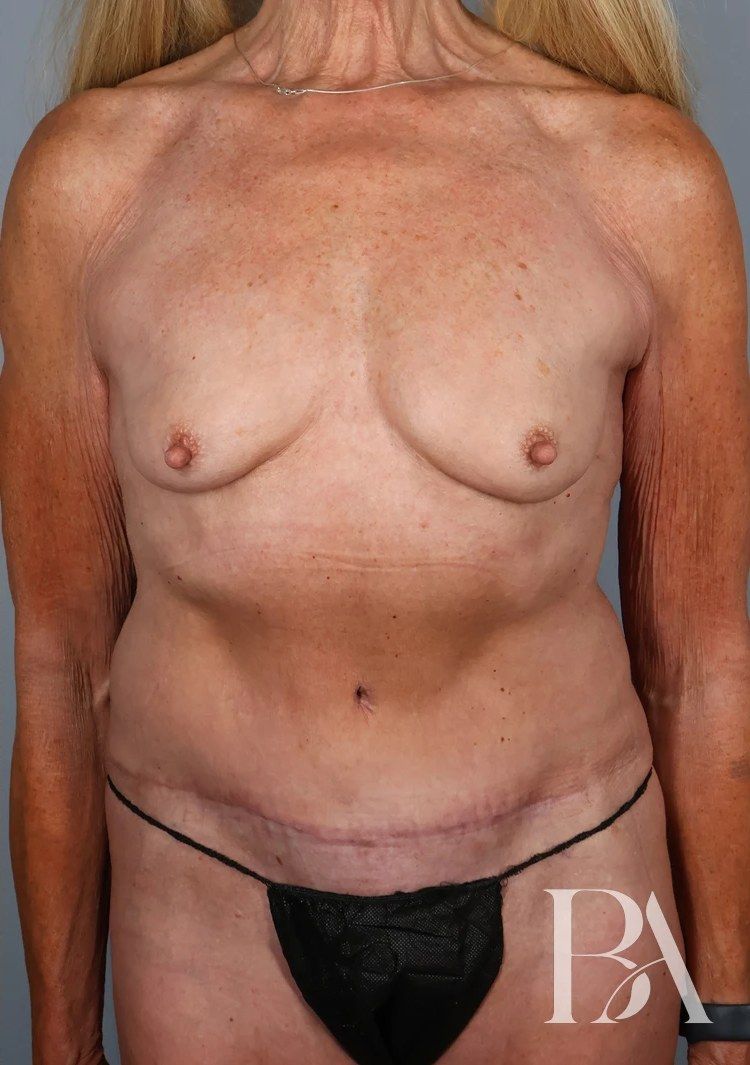 After — Tummy Tuck (Abdominoplasty)