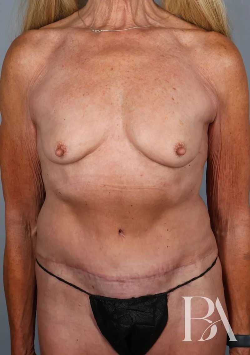After — Tummy Tuck (Abdominoplasty)