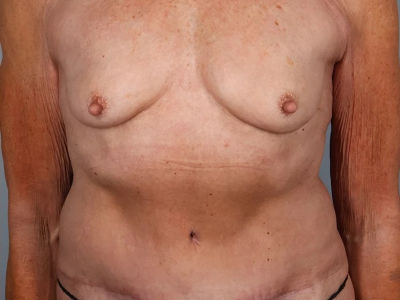 After — Tummy Tuck (Abdominoplasty)