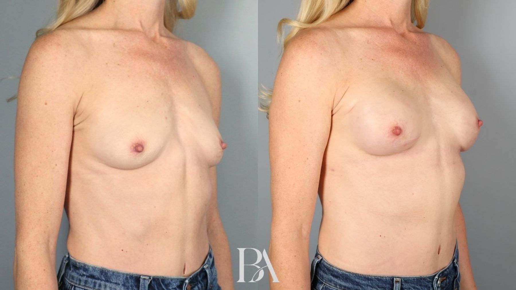 Direct-to-Implant Reconstruction before and after — oblique view, Dr. Beina Azadgoli, Beverly Hills
