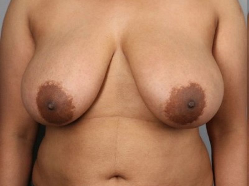Before — Breast Reduction
