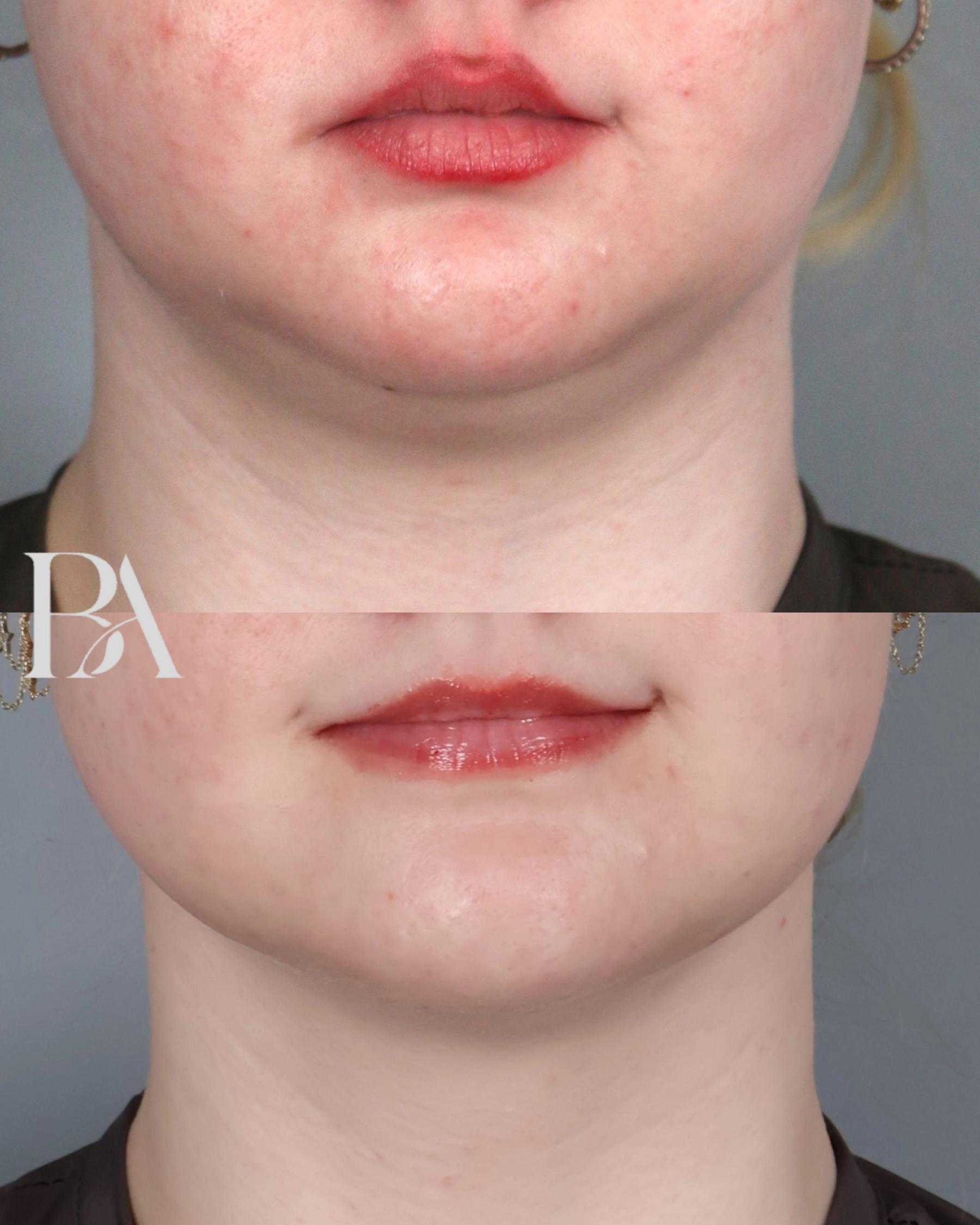 Submental Liposuction before and after — front view, Dr. Beina Azadgoli, Beverly Hills