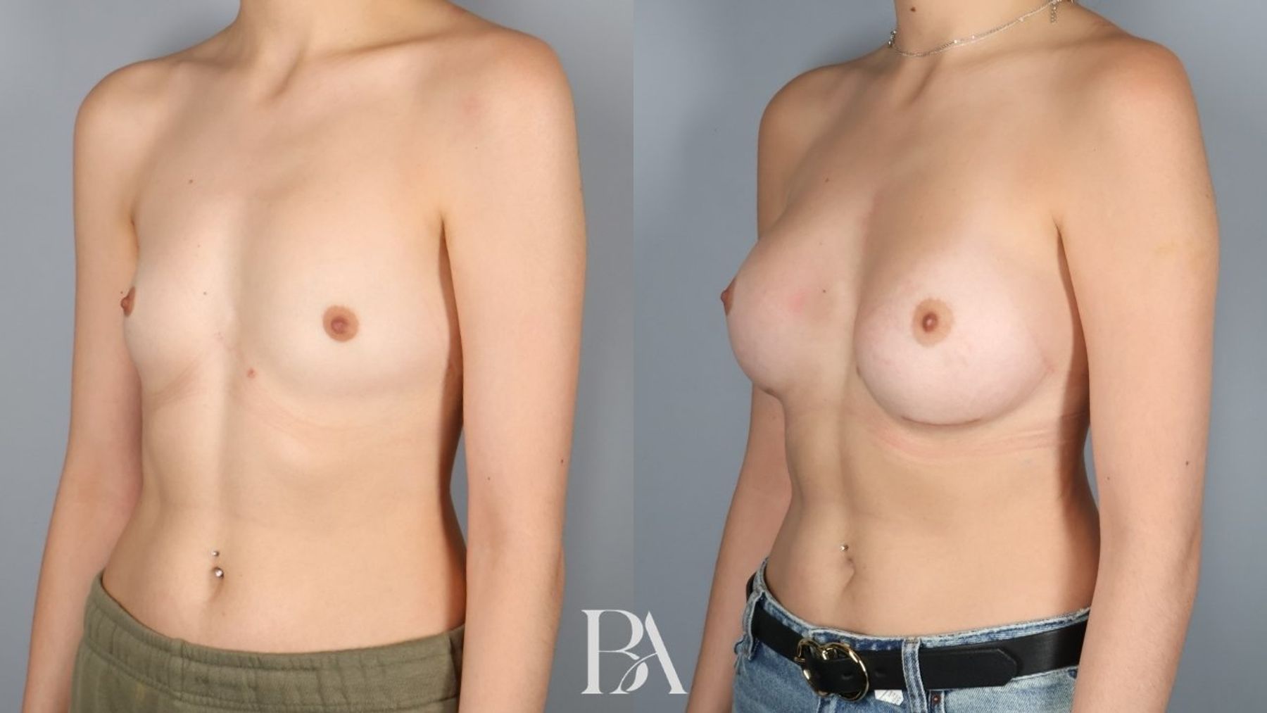 Breast augmentation before and after — three-quarter view, Dr. Beina Azadgoli, Beverly Hills