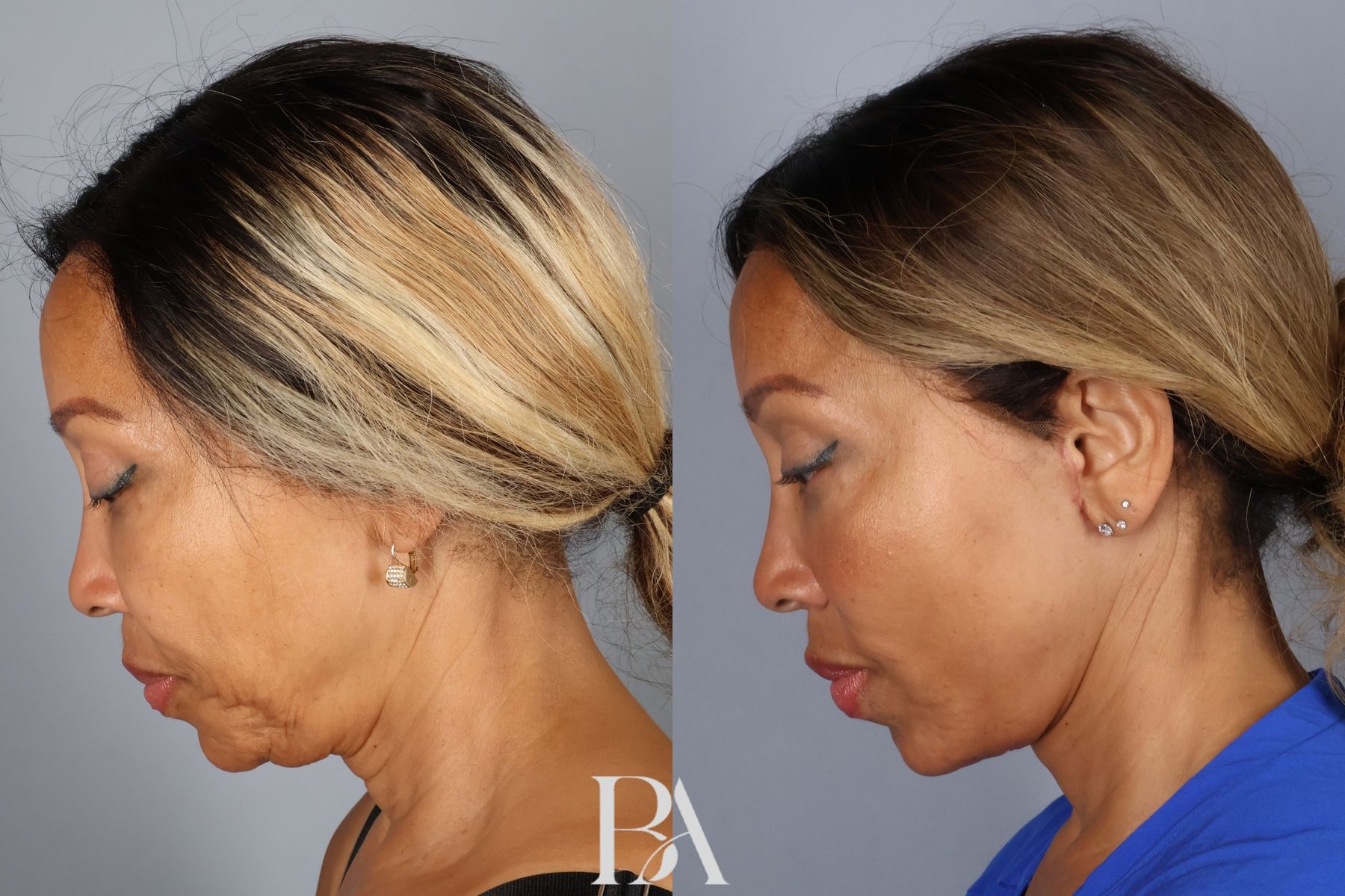 Face/Neck Lift before and after — detail view, Dr. Beina Azadgoli, Beverly Hills