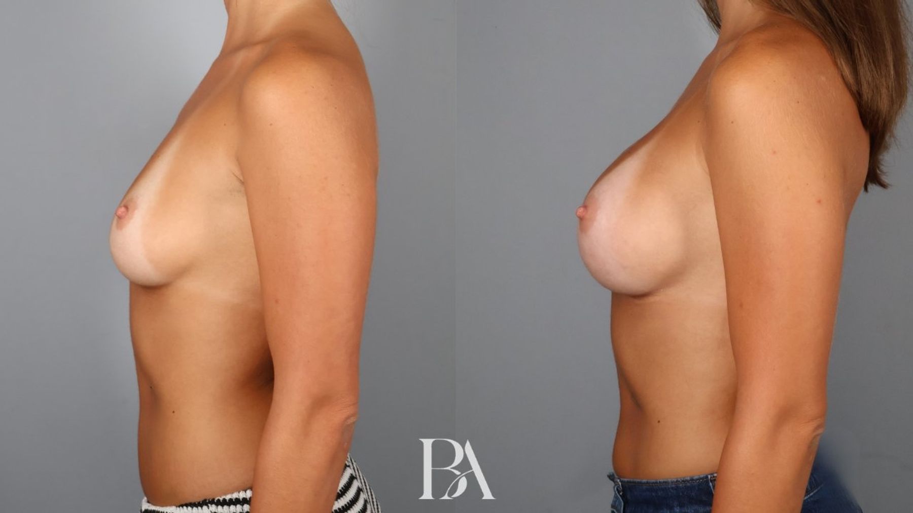 Breast augmentation before and after — side view, Dr. Beina Azadgoli, Beverly Hills