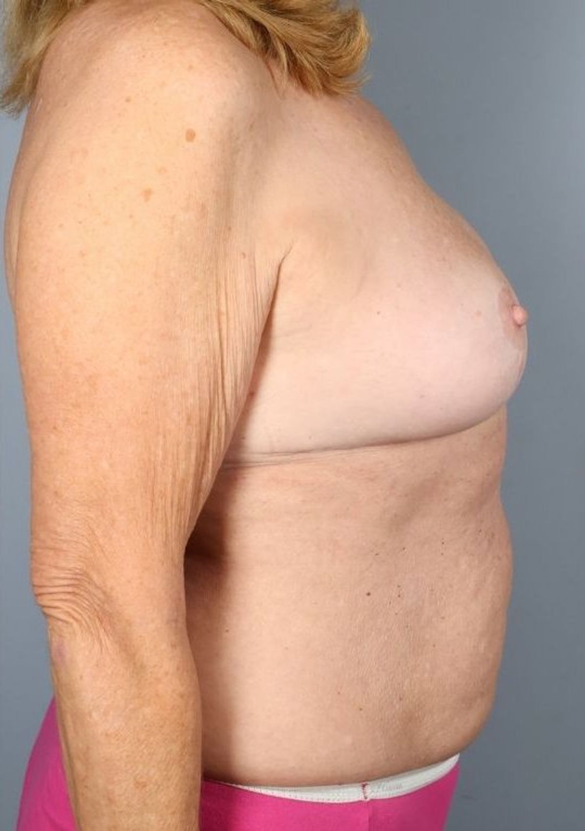Breast implant removal after — detail view, Dr. Beina Azadgoli, Beverly Hills
