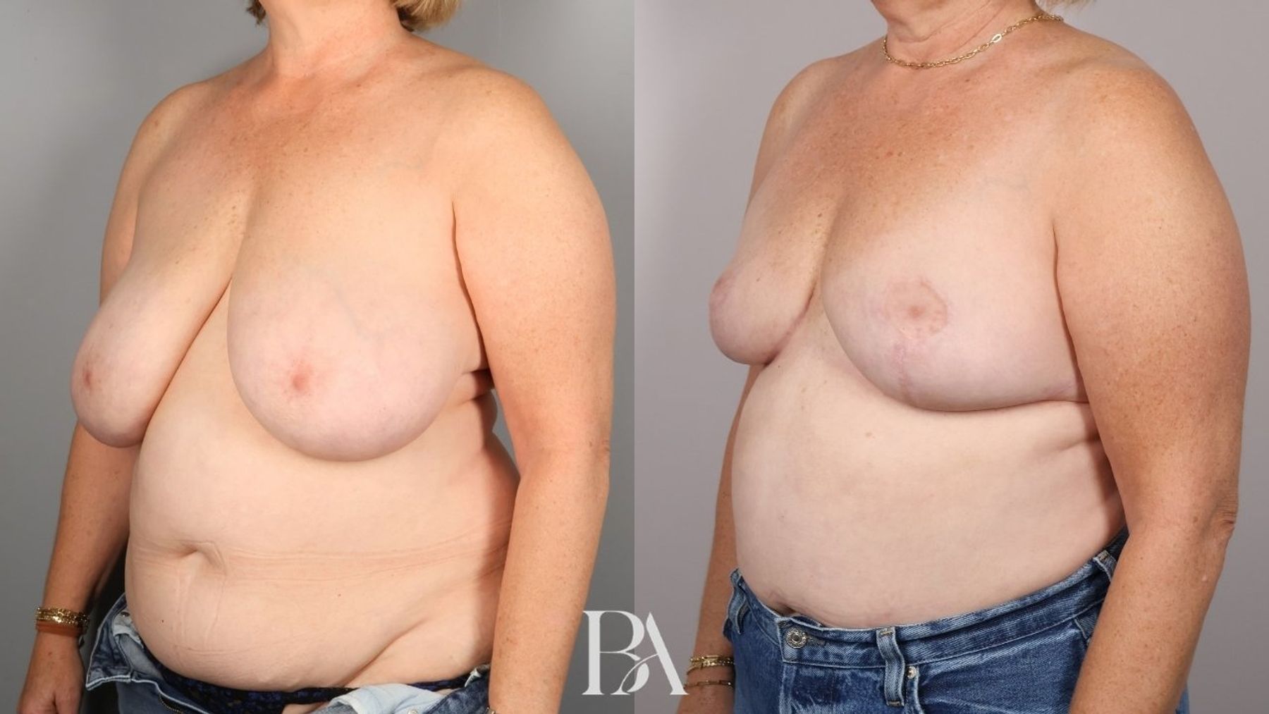 Breast reduction before and after — three-quarter view, Dr. Beina Azadgoli, Beverly Hills