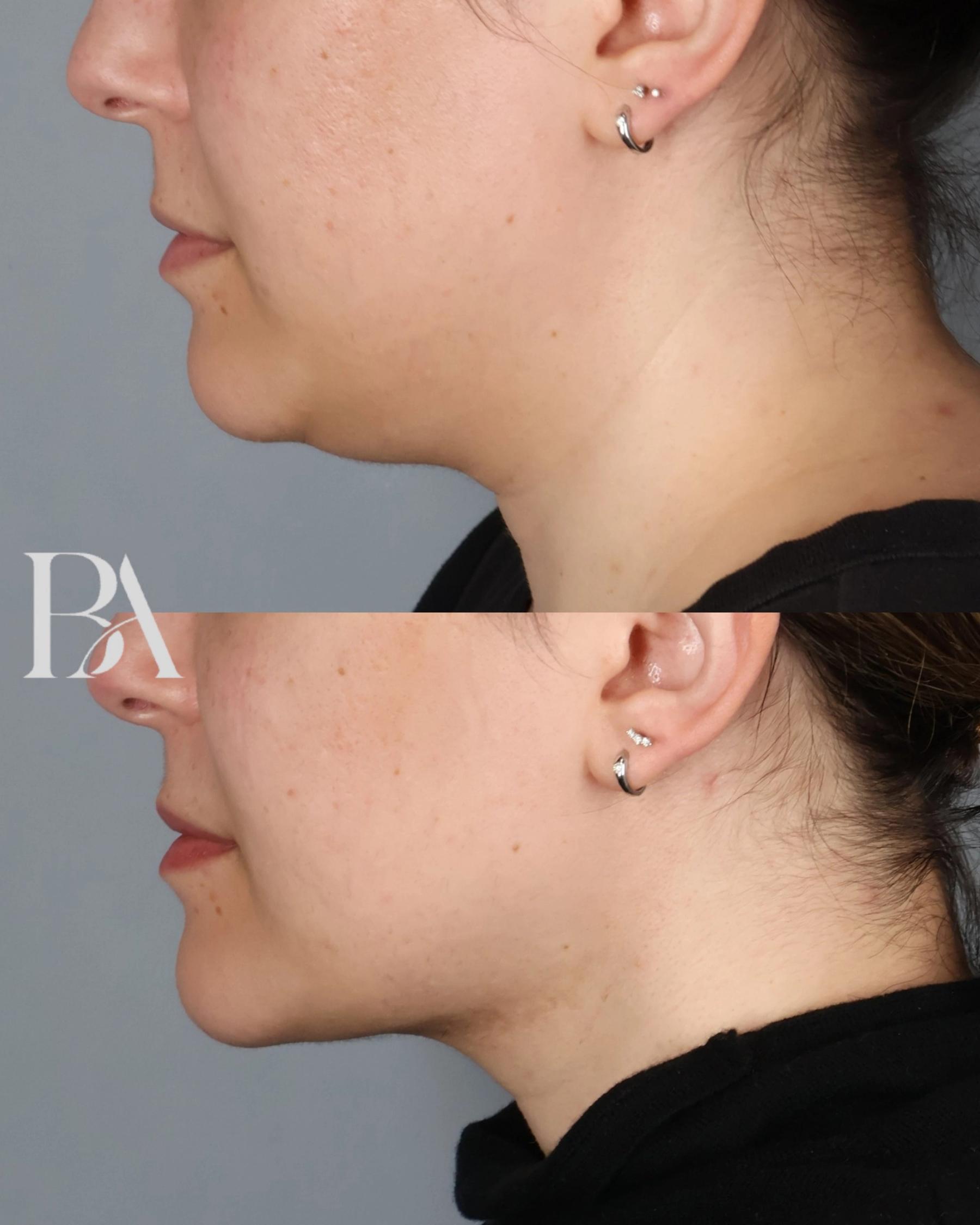Submental Liposuction before and after — side view, Dr. Beina Azadgoli, Beverly Hills