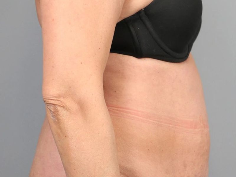 Before — Tummy Tuck (Abdominoplasty)