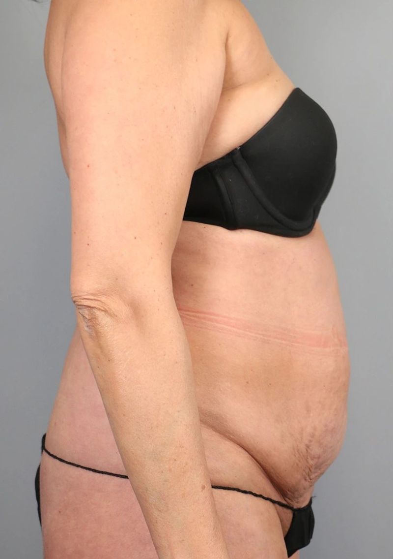 Before — Tummy Tuck (Abdominoplasty)