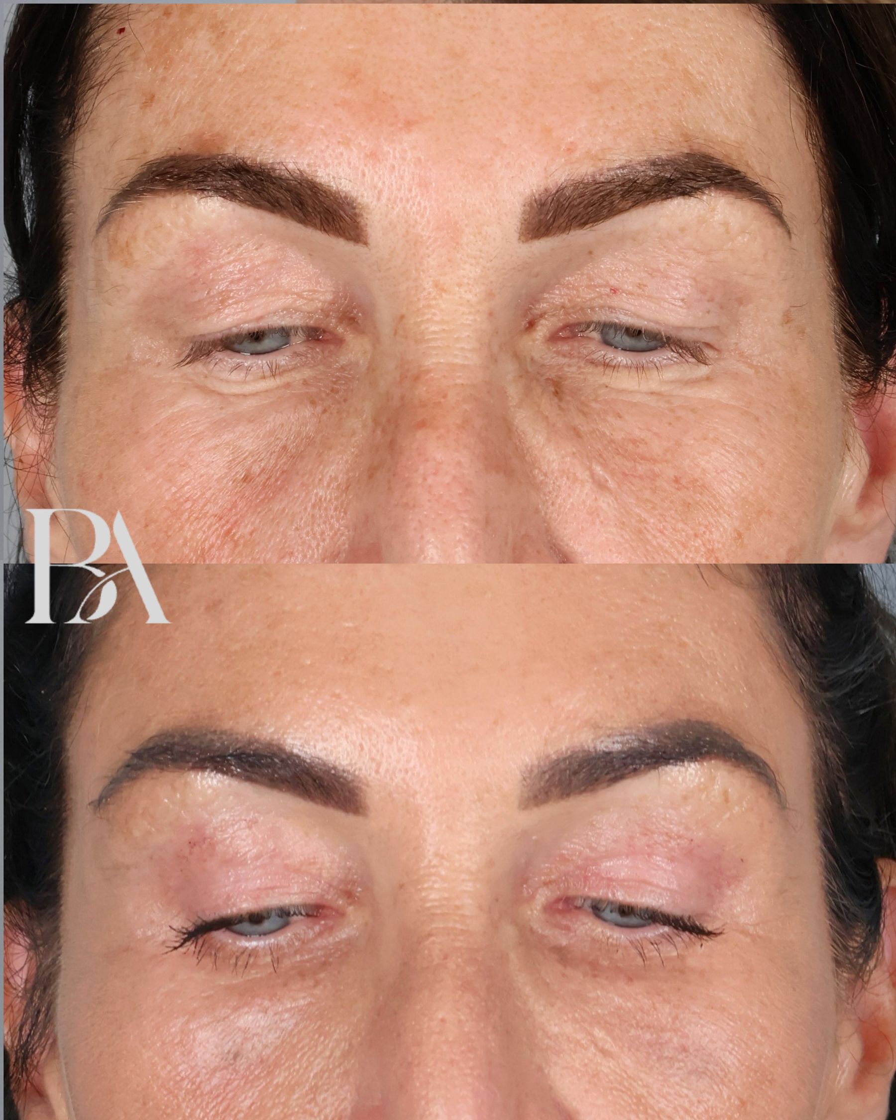 Upper Blepharoplasty before and after — detail view, Dr. Beina Azadgoli, Beverly Hills