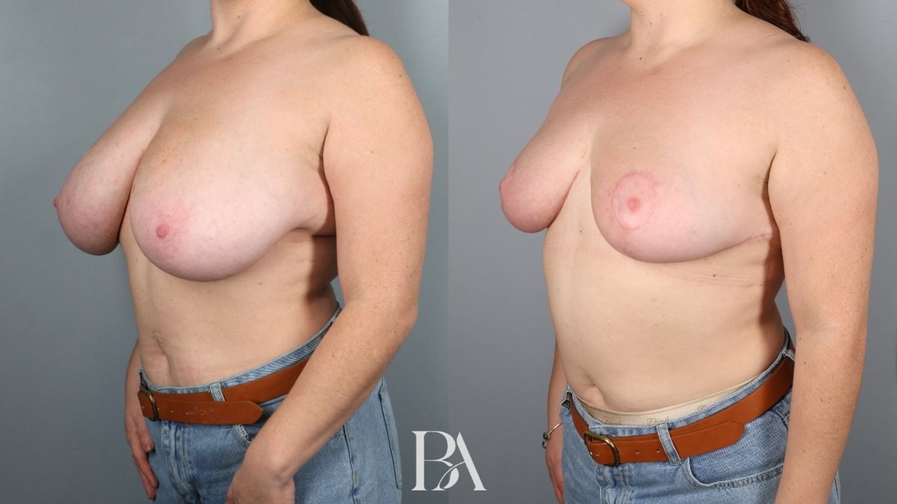 Breast reduction before and after — three-quarter view, Dr. Beina Azadgoli, Beverly Hills
