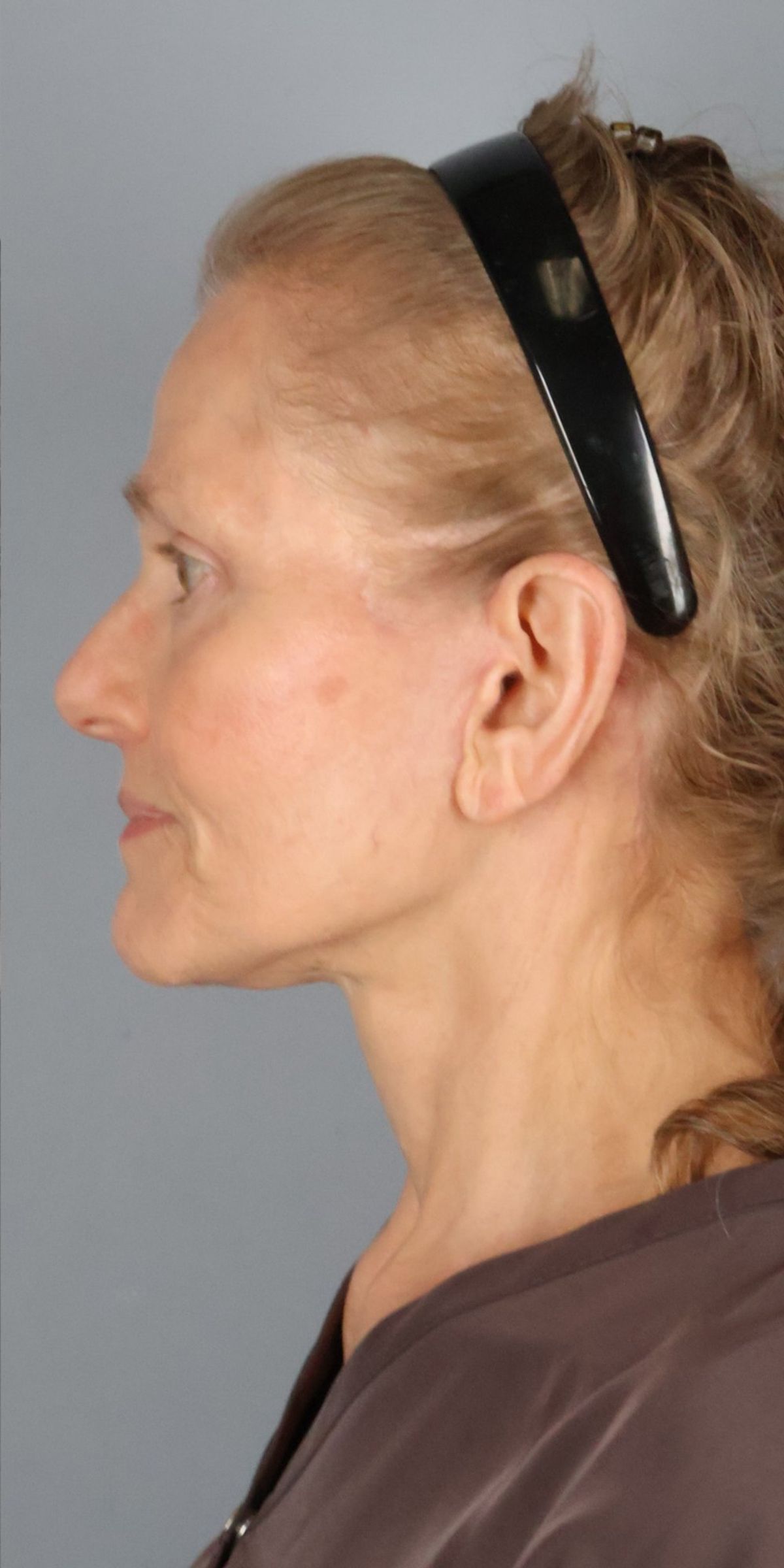 Face/neck lift after — side view, Dr. Beina Azadgoli, Beverly Hills