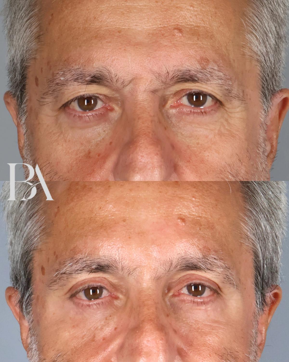 Before and after — Upper Blepharoplasty