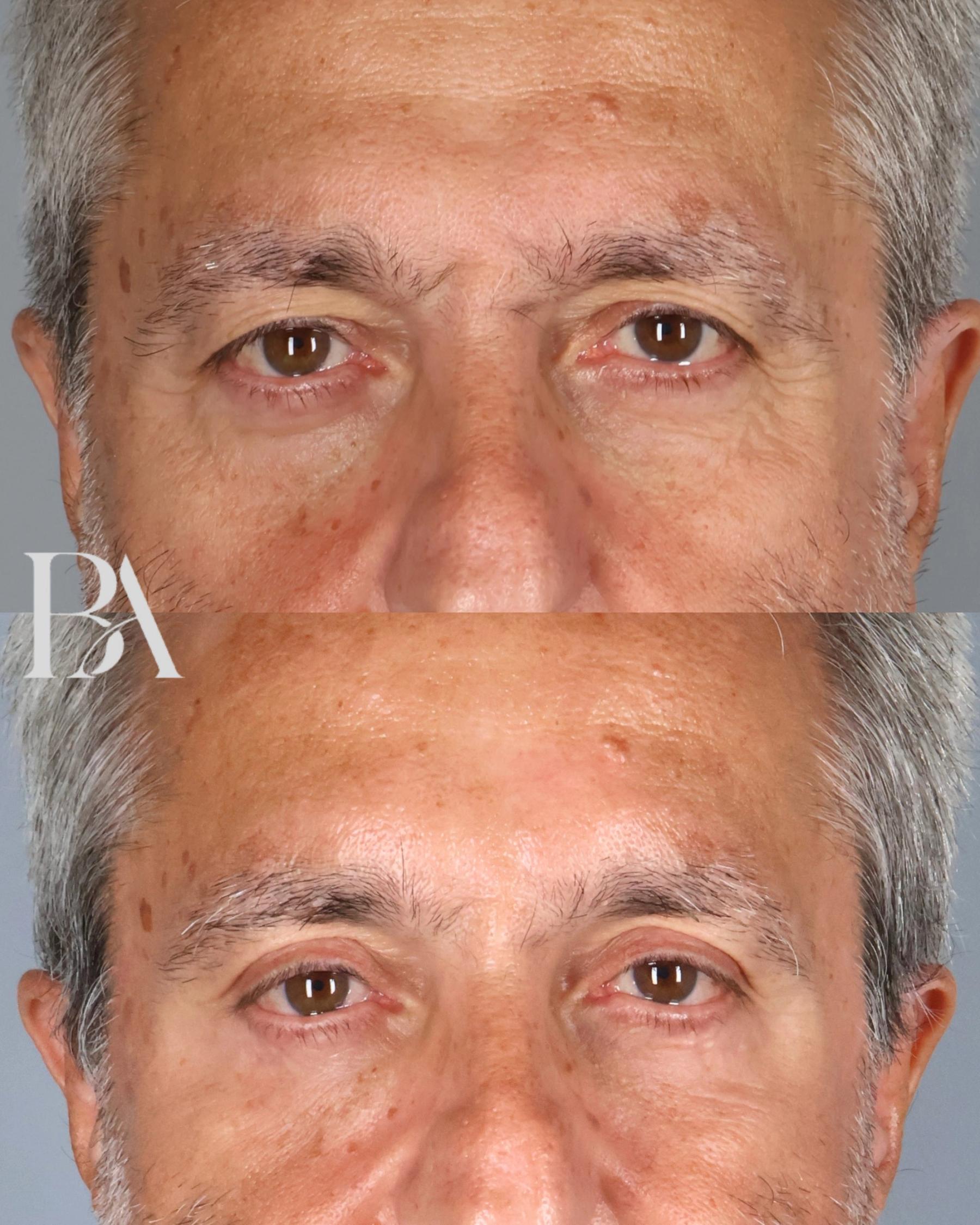 Upper Blepharoplasty before and after — front view, Dr. Beina Azadgoli, Beverly Hills