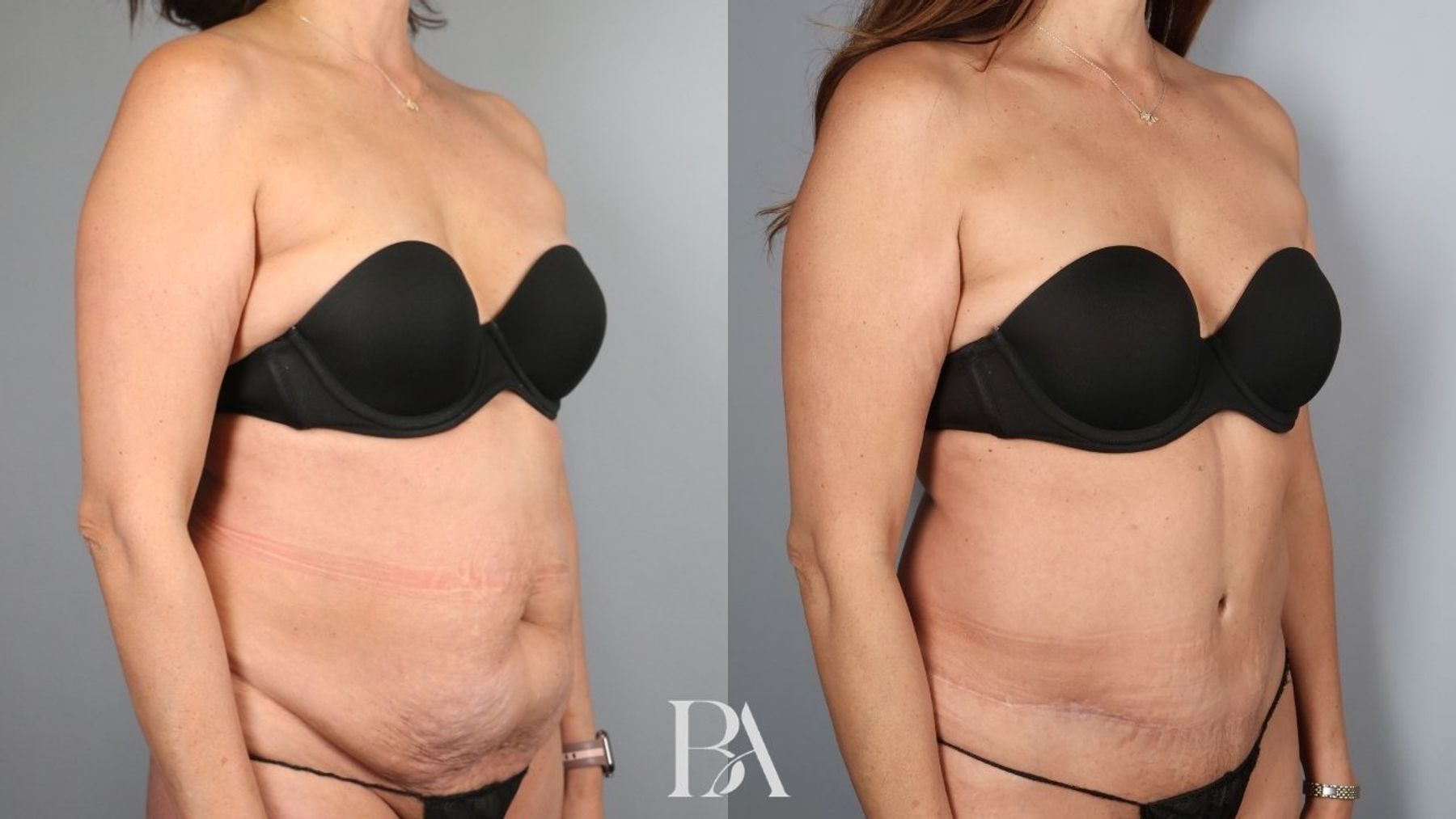 Tummy tuck before and after — oblique view, Dr. Beina Azadgoli, Beverly Hills