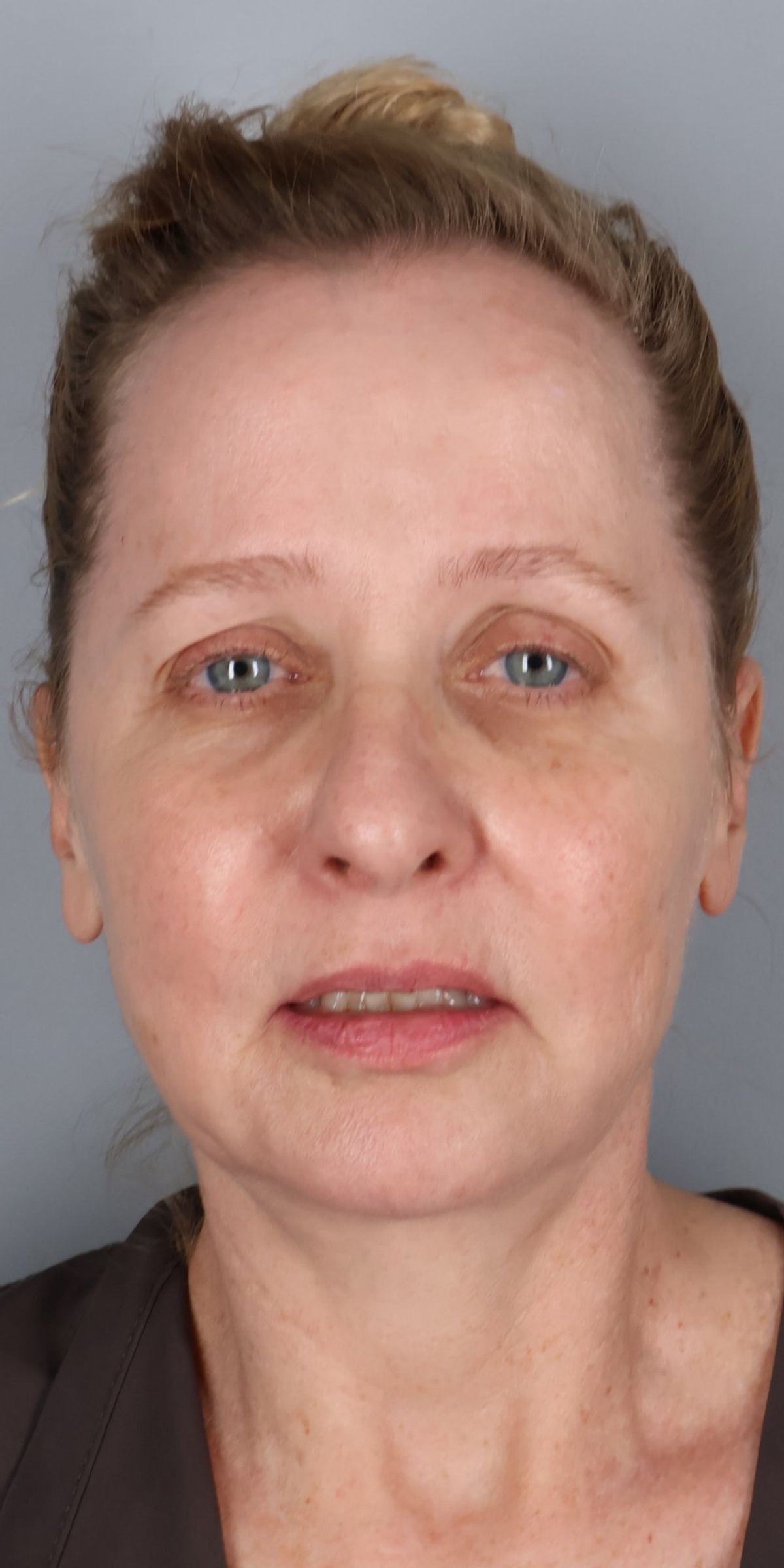 Face/neck lift before — detail view, Dr. Beina Azadgoli, Beverly Hills