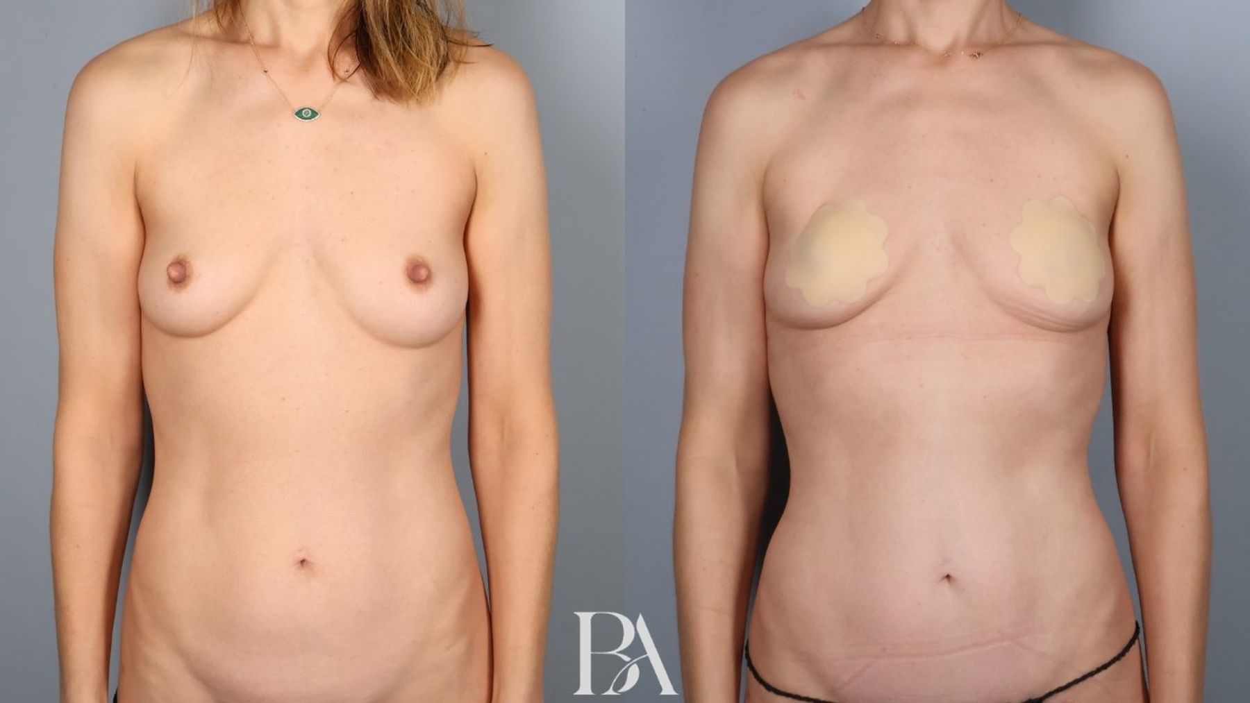 Tummy tuck before and after — front view, Dr. Beina Azadgoli, Beverly Hills