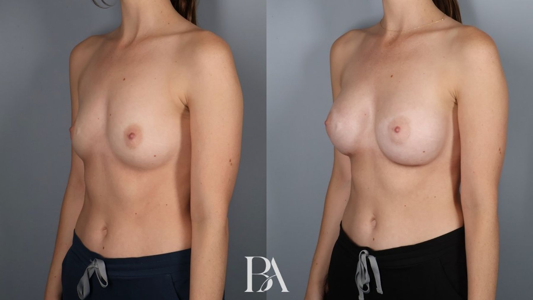 Breast augmentation before and after — three-quarter view, Dr. Beina Azadgoli, Beverly Hills