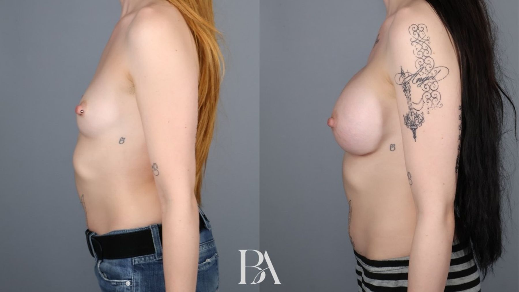Breast augmentation before and after — side view, Dr. Beina Azadgoli, Beverly Hills