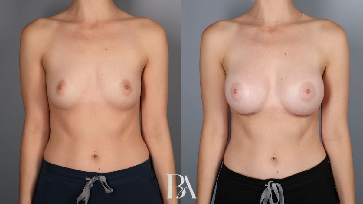 Before and after — Breast Augmentation