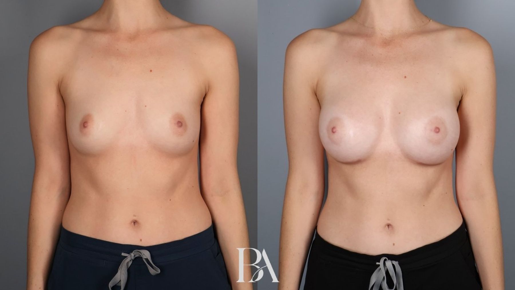 Breast augmentation before and after — front view, Dr. Beina Azadgoli, Beverly Hills