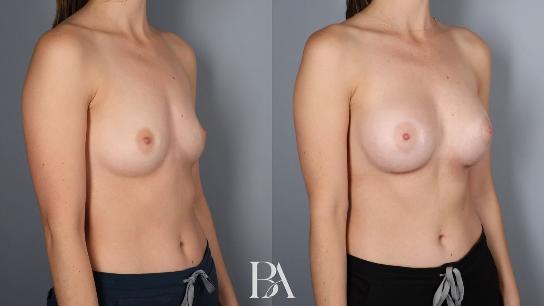 Breast augmentation before and after — oblique view, Dr. Beina Azadgoli, Beverly Hills