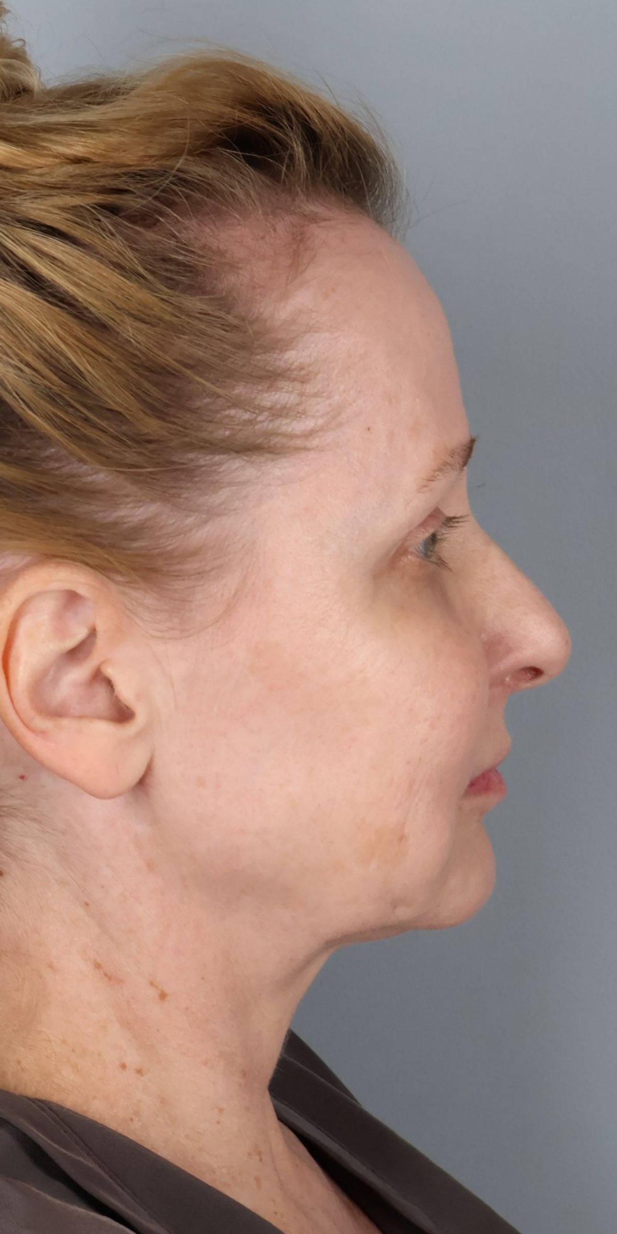 Face/neck lift before — side view, Dr. Beina Azadgoli, Beverly Hills