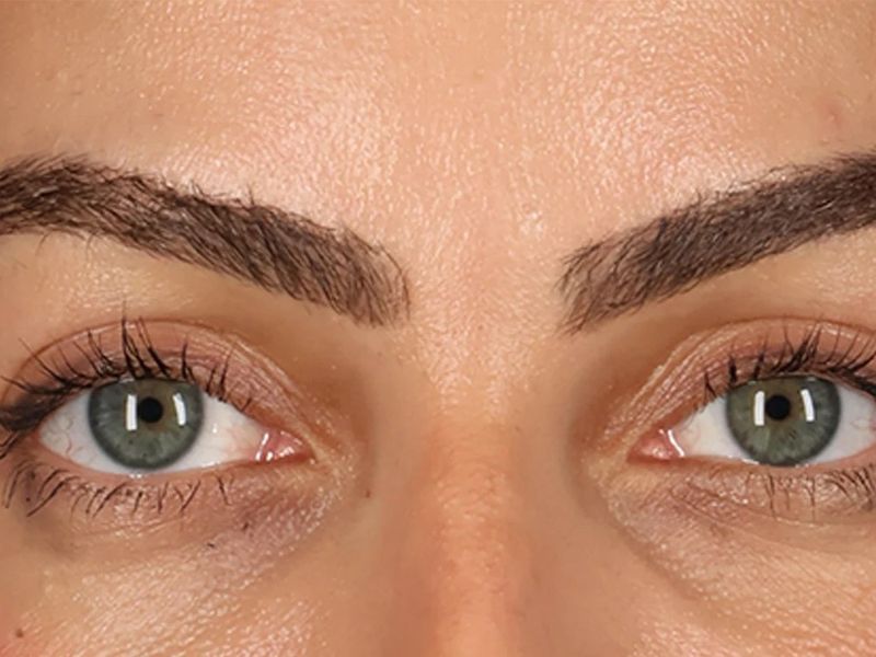 After — Upper Blepharoplasty