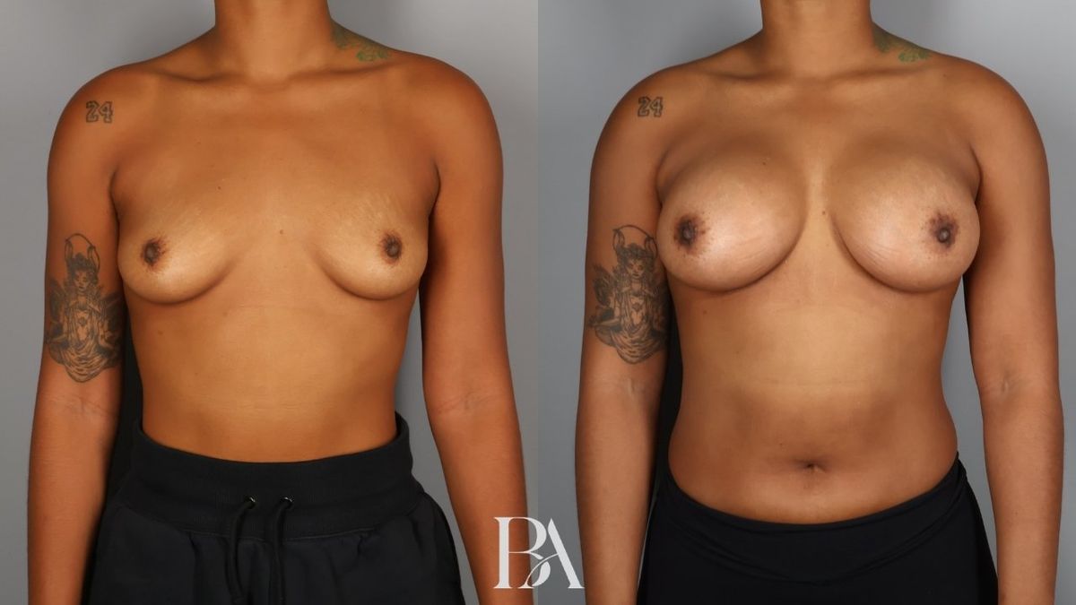 Before and after — Breast Augmentation