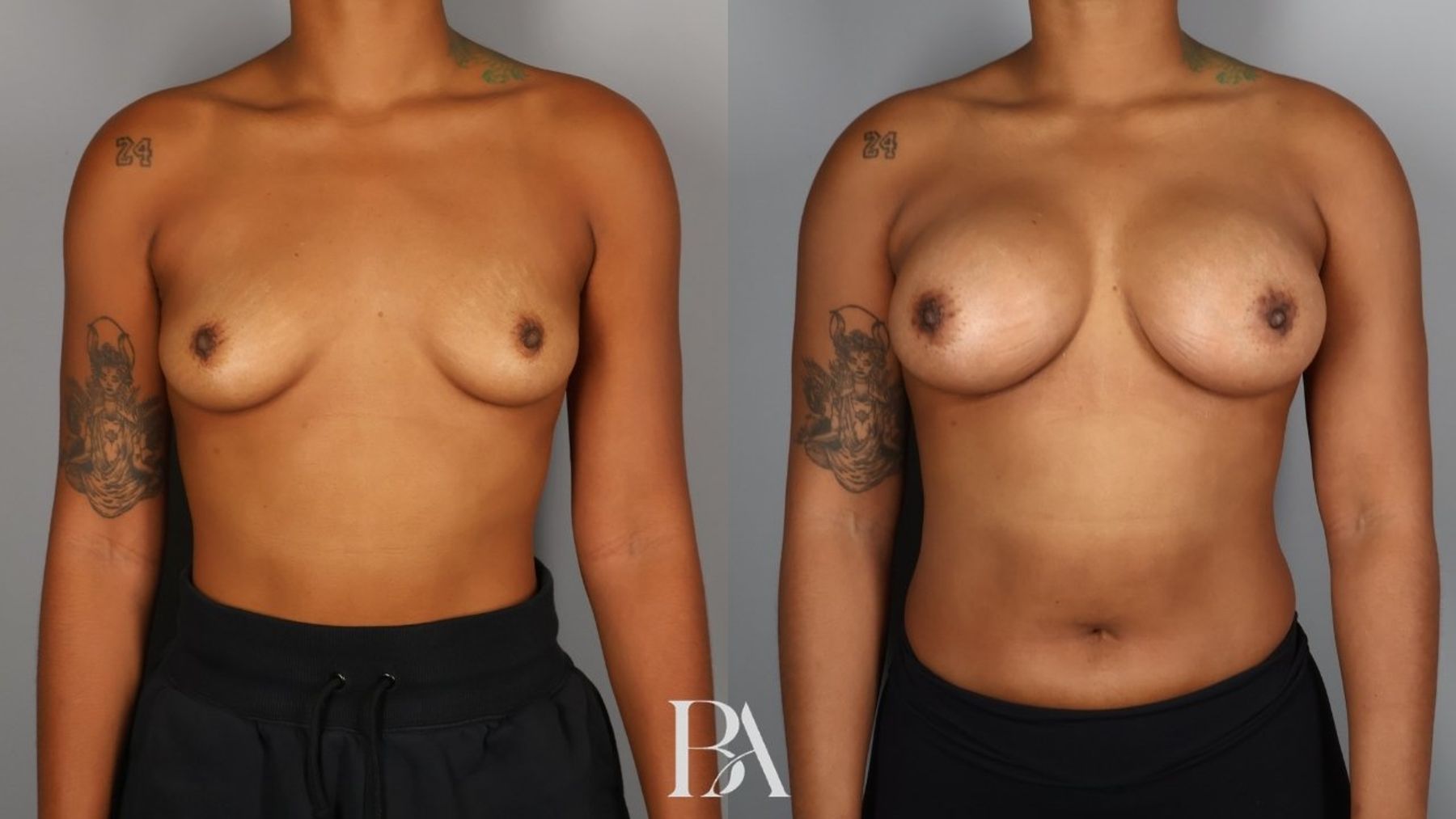 Breast augmentation before and after — front view, Dr. Beina Azadgoli, Beverly Hills