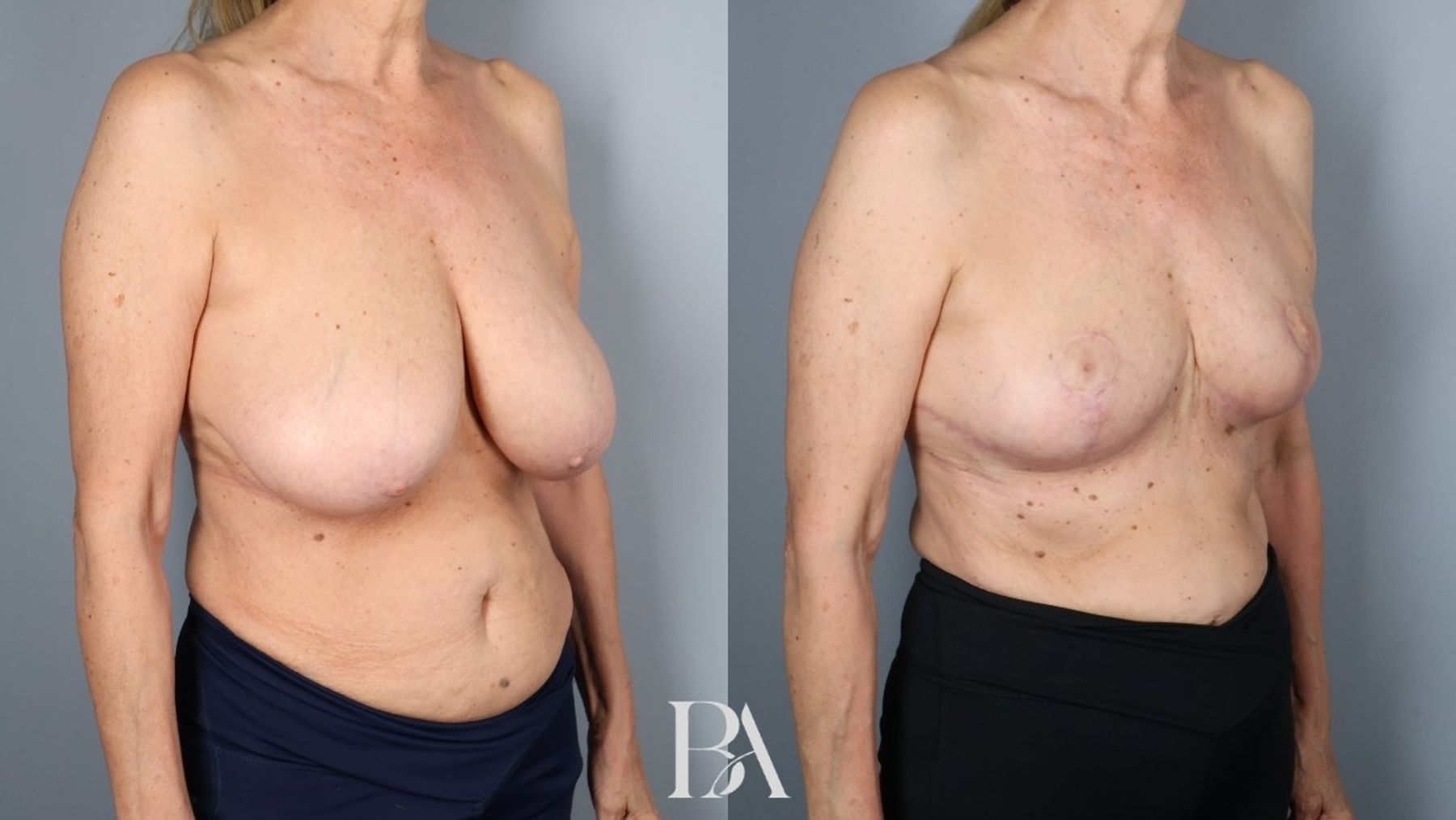 Breast reduction before and after — oblique view, Dr. Beina Azadgoli, Beverly Hills