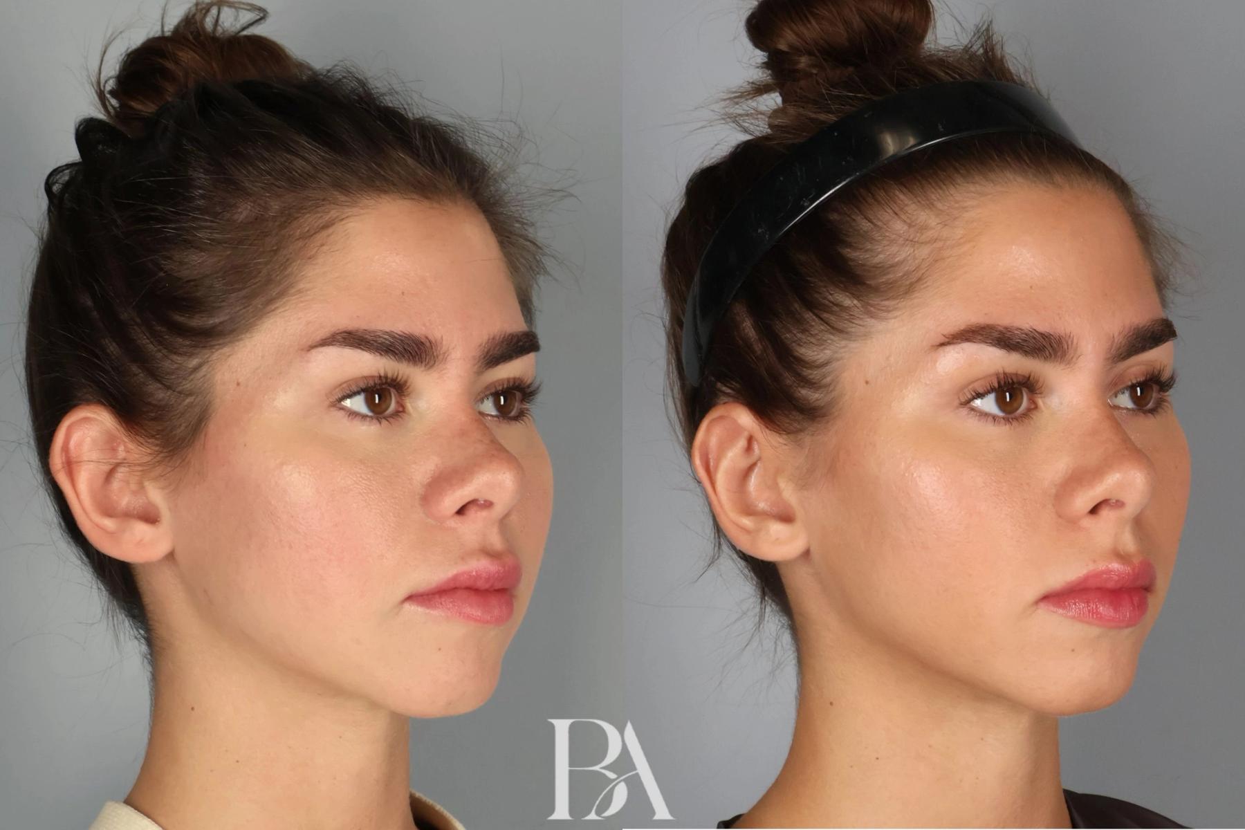 Ear Pinning before and after — three-quarter view, Dr. Beina Azadgoli, Beverly Hills