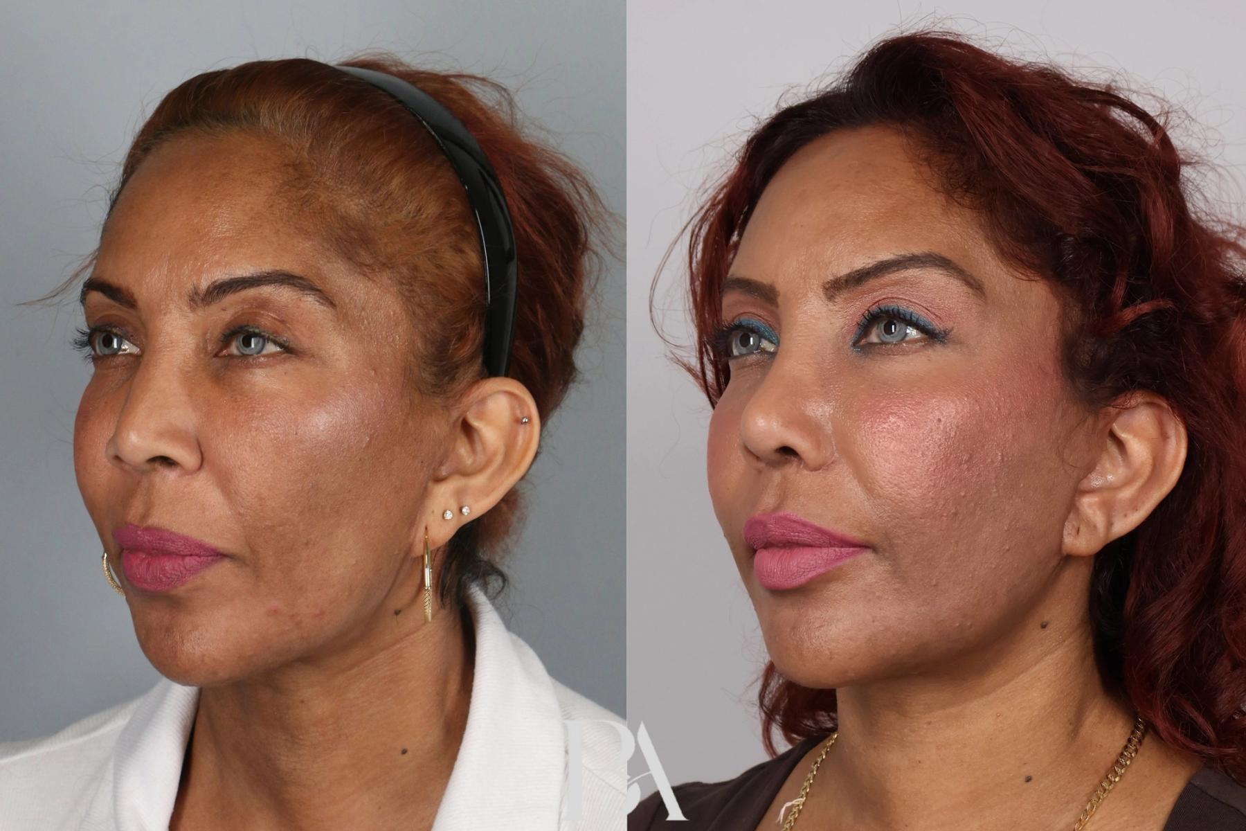 Rhinoplasty before and after — three-quarter view, Dr. Beina Azadgoli, Beverly Hills