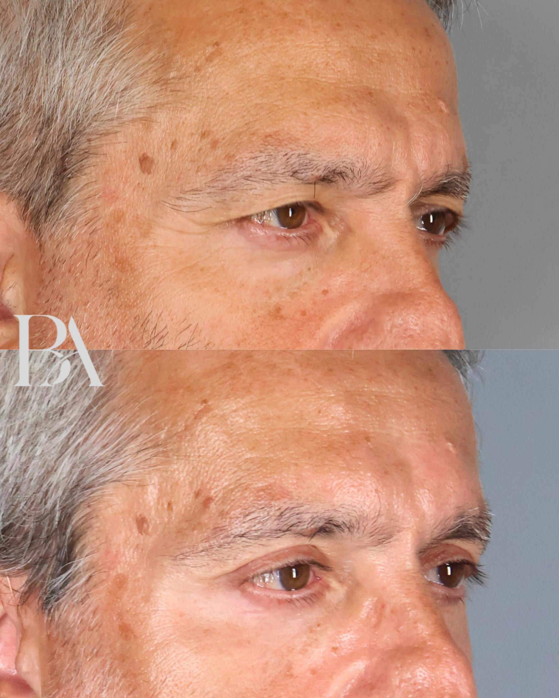 Upper Blepharoplasty before and after — oblique view, Dr. Beina Azadgoli, Beverly Hills