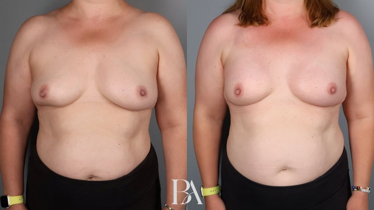 Before and after — Direct-to-Implant Reconstruction