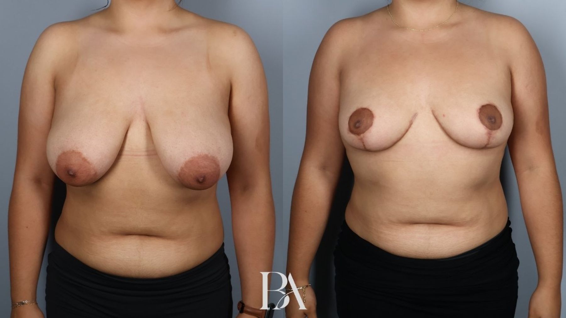 Breast reduction before and after — front view, Dr. Beina Azadgoli, Beverly Hills