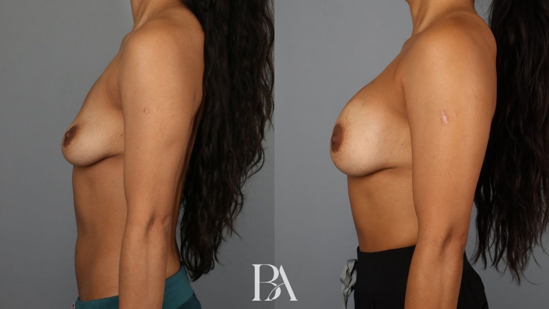 Breast augmentation before and after — side view, Dr. Beina Azadgoli, Beverly Hills