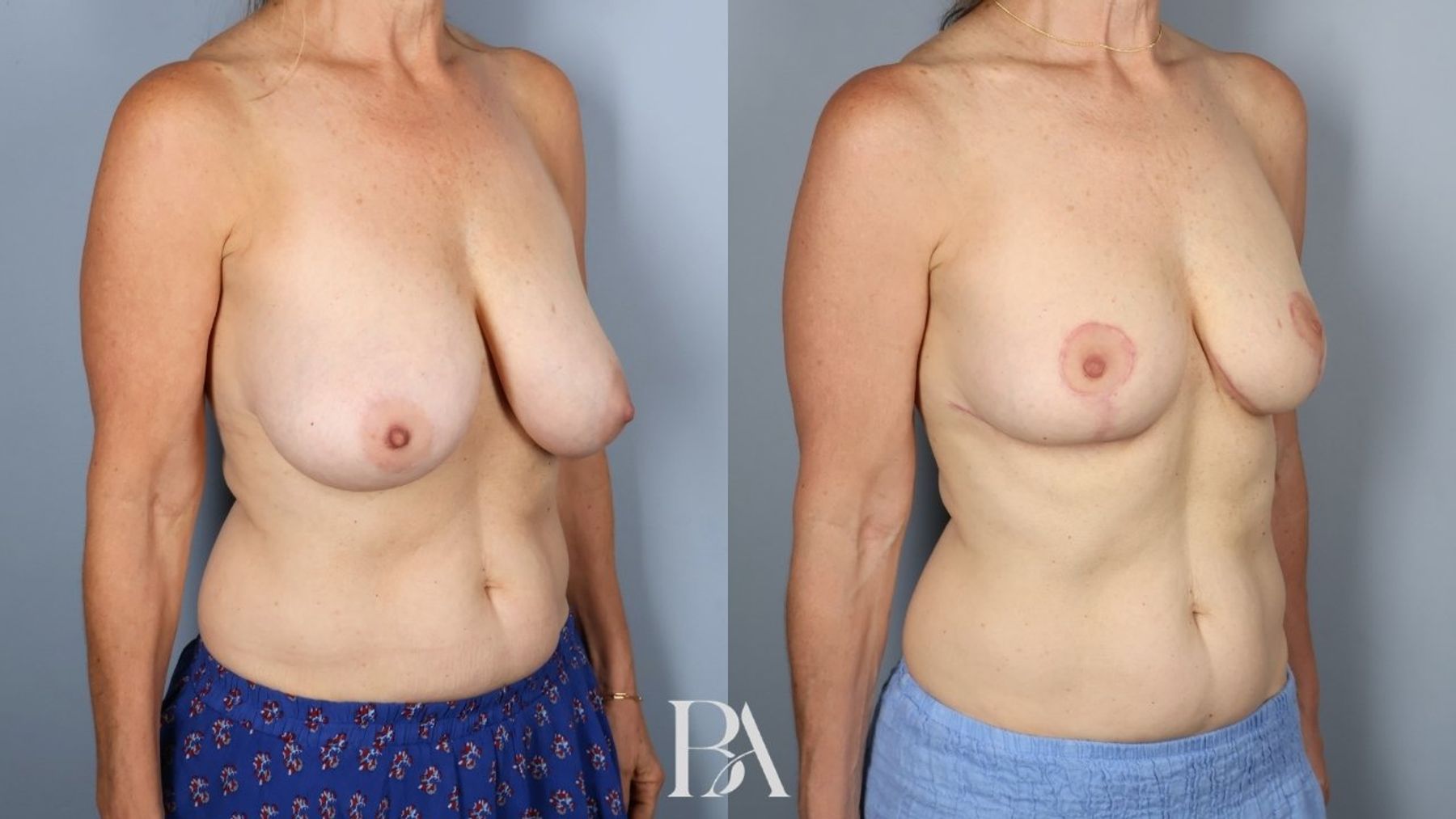 Breast reduction before and after — oblique view, Dr. Beina Azadgoli, Beverly Hills