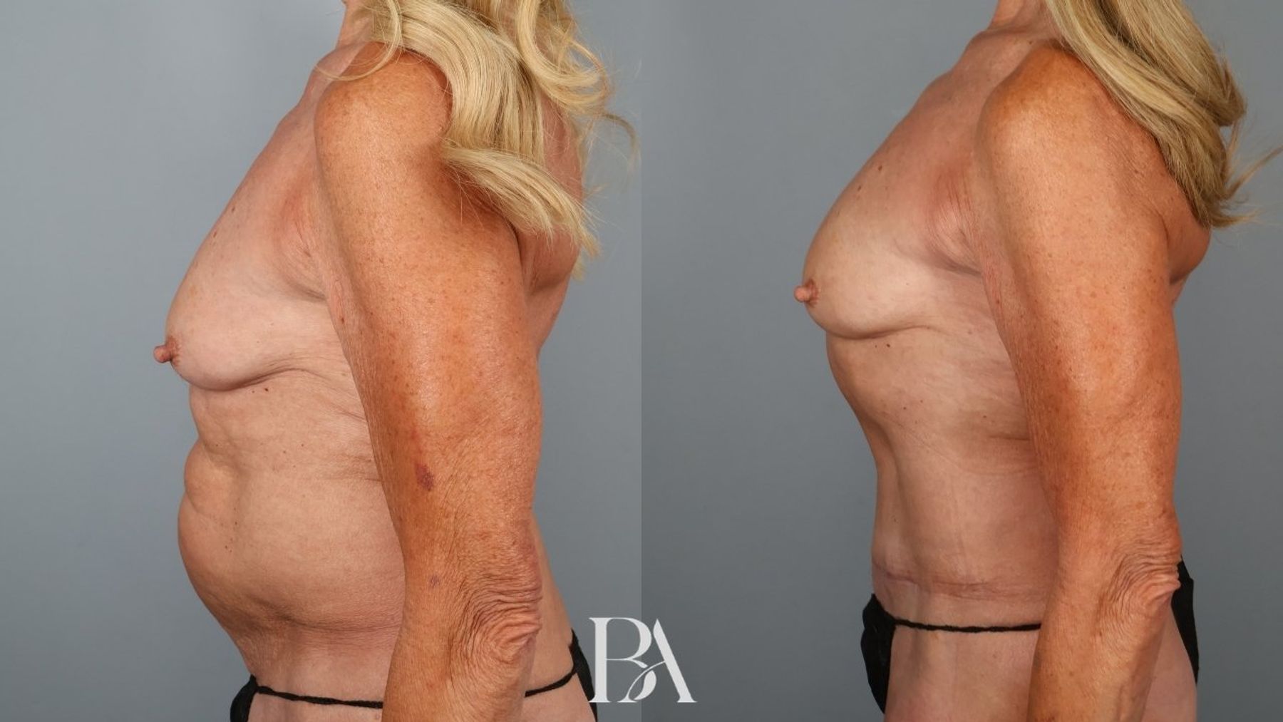 Tummy tuck before and after — side view, Dr. Beina Azadgoli, Beverly Hills